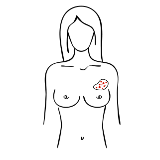 Changements mamelonnaires